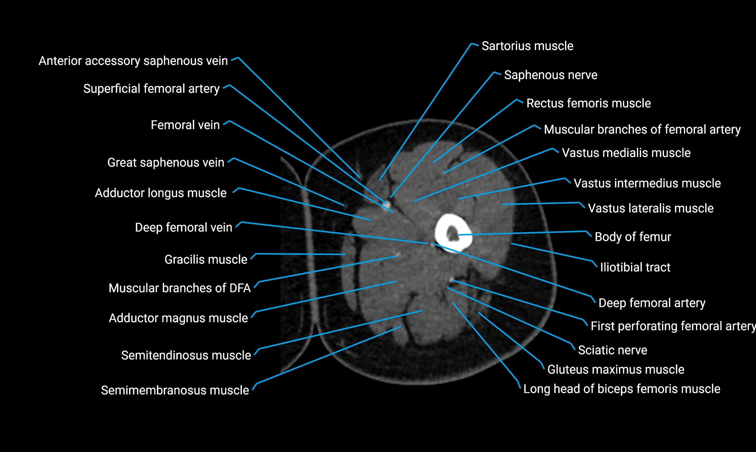 CT lower limb axial cross sectional anatomy labelled image 36 (2).webp